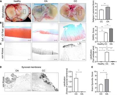 Chondrocytes From Osteoarthritic and Chondrocalcinosis Cartilage Represent Different Phenotypes